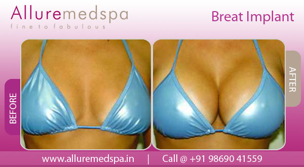 breast implants mumbai india